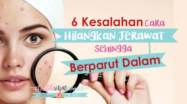 6 Kesalahan Cara Hilangkan Jerawat Sehingga parut Berlubang