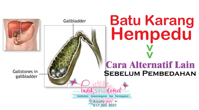 Batu Karang Hempedu Cara Alternatif Lain Sebelum Pembedahan