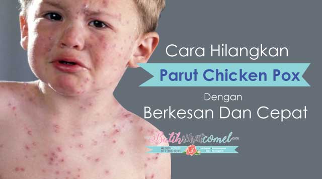 Cara Hilangkan Parut Chicken Pox Dengan Berkesan Dan Cepat