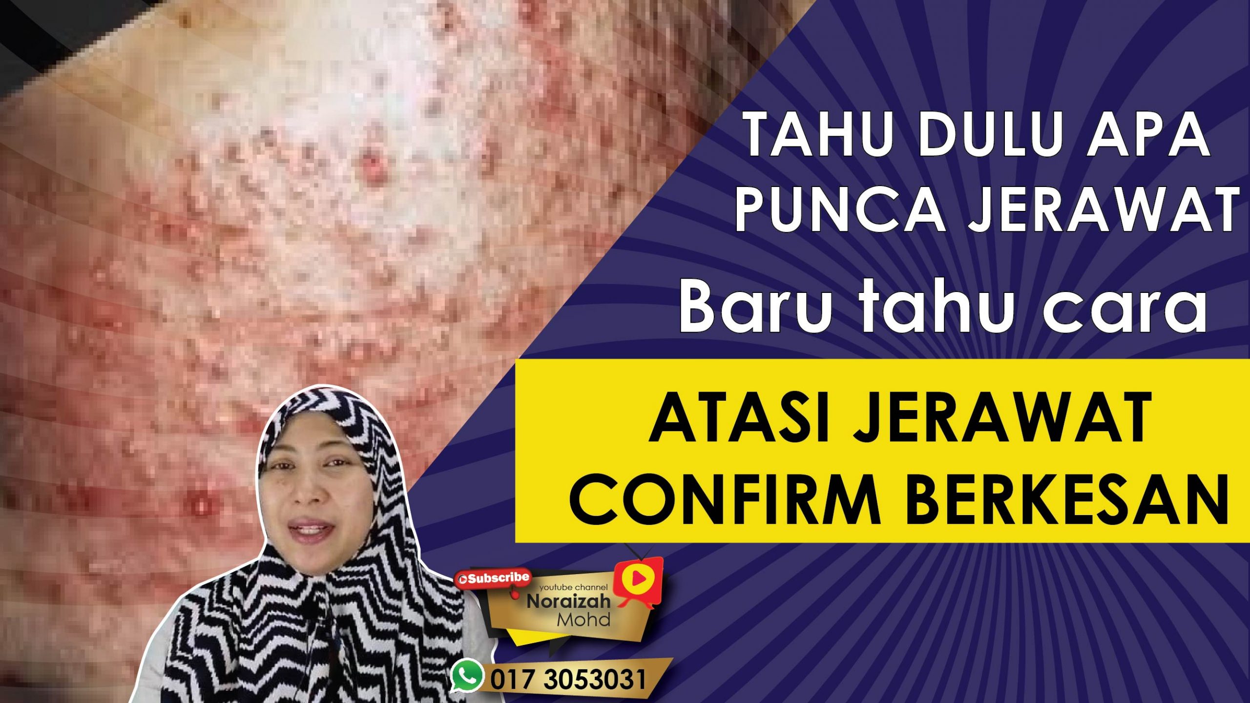 Cara Hilangkan Jerawat Sangat Berkesan
