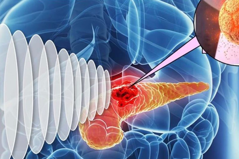 Cara Mengesan Kanser Dalam Tubuh Manusia