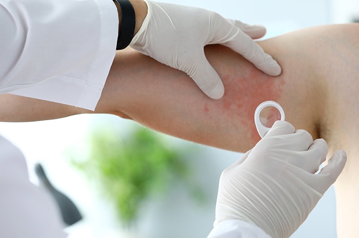 Histamin Punca Alergik Teruk ?