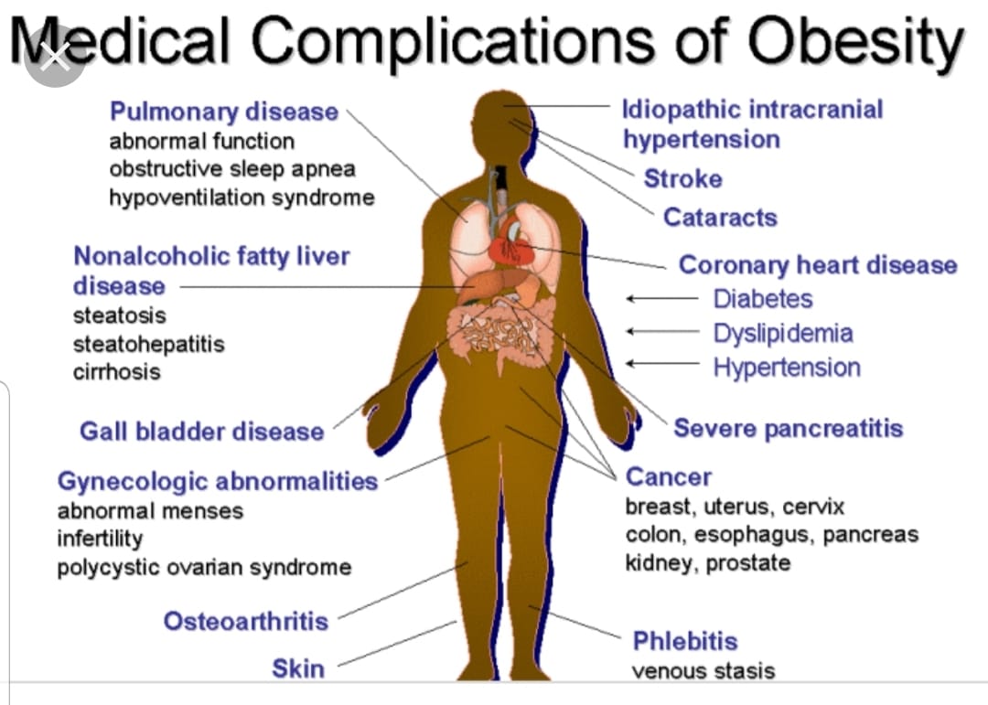kencing manis obesiti buncit