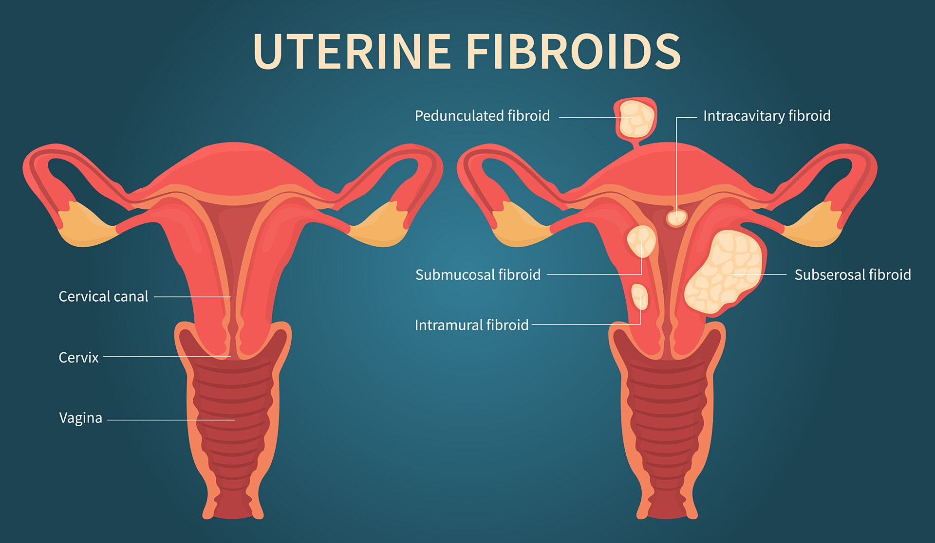 Cara Atasi Fibroid Tanpa Pembedahan Dengan Berkesan