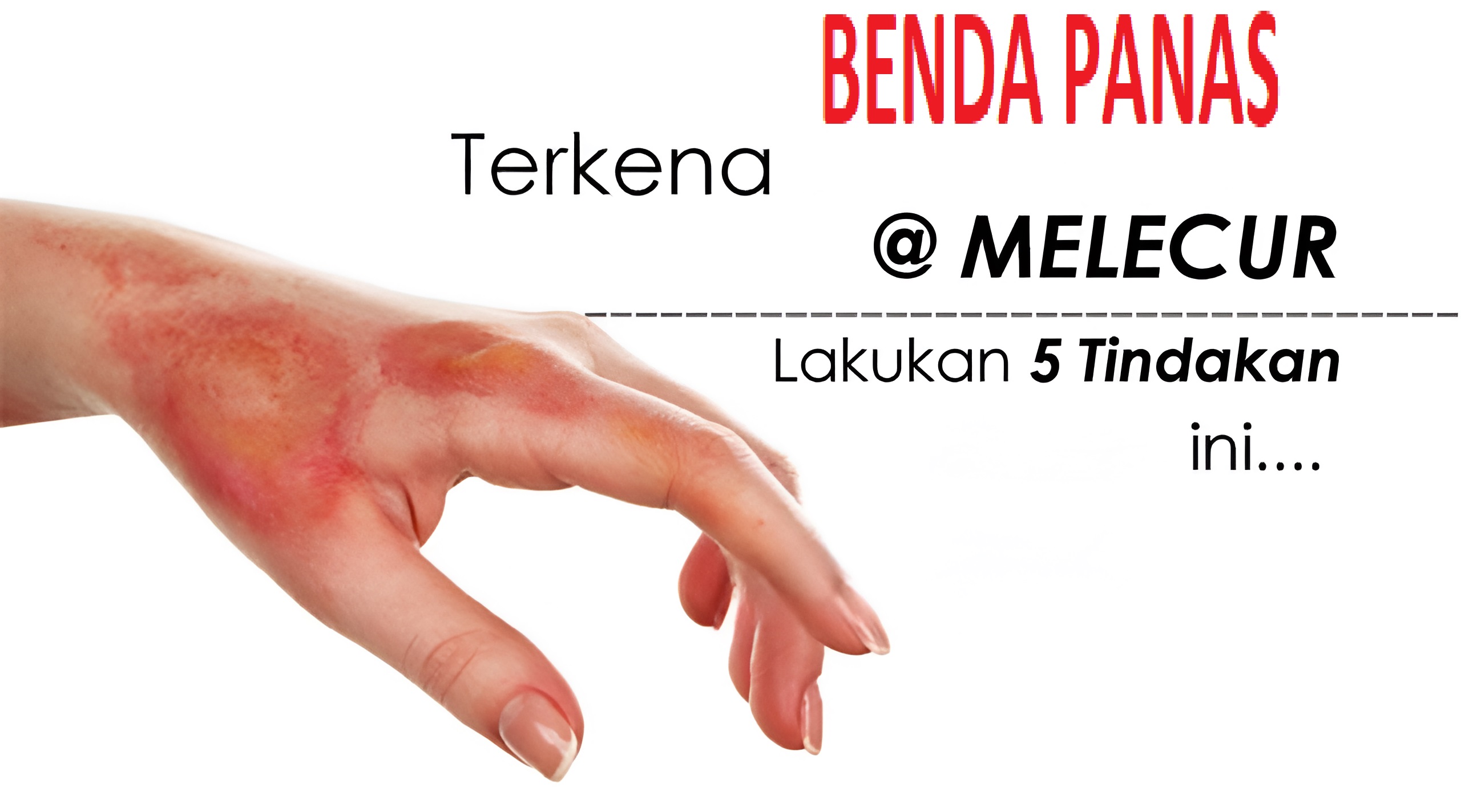 5 Tindakan Awal Bila Terkena Air Panas Elak Melecur Teruk